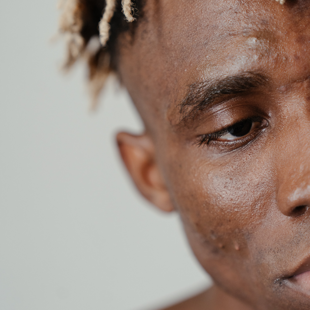How To Care For Acne Prone Skin | The Virtual Aesthetic Clinic